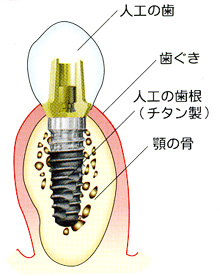 インプラント