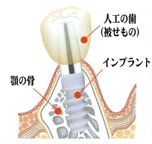 インプラントとは？